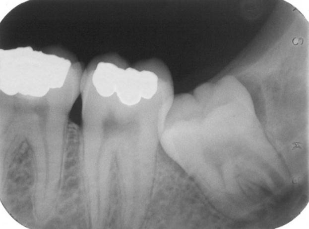 Best-dental-implant-clinic-in-ashok-vihar