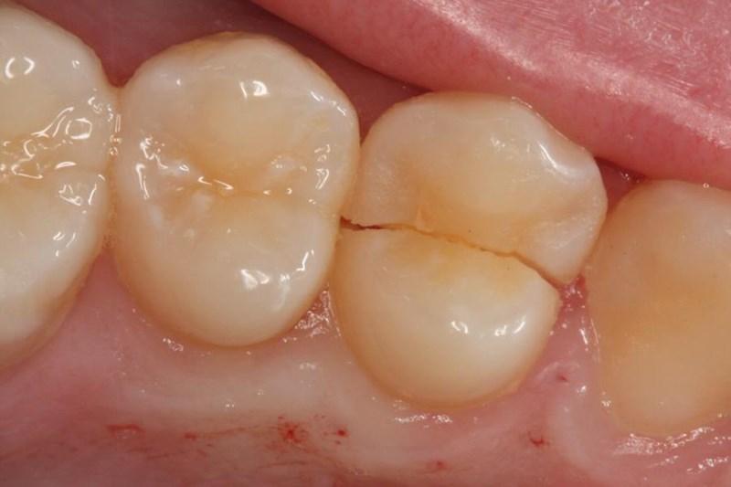 Dental-implant-in-north-delhi