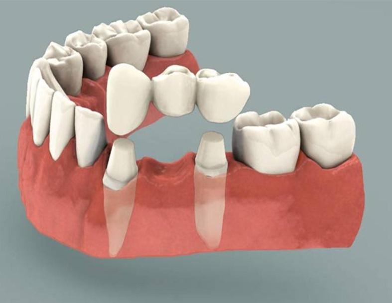 Dental-implant-india-dentisit-in-north-delhi