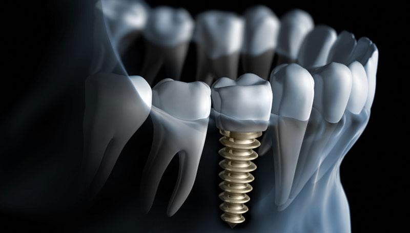 Dentalimplantindia-dental-implant-in-india