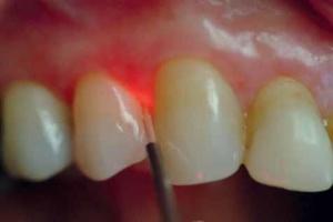 Detnal-implant-india-dentist-in-ashok-viahr