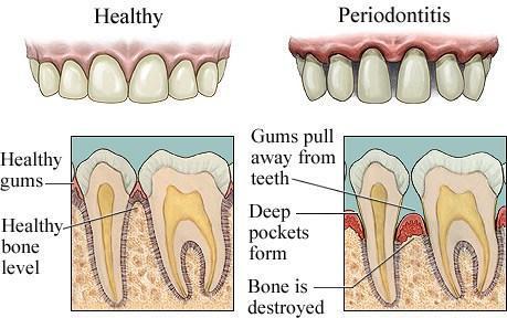 dental-clinic-in-nrth-delhi-dental-implant-india