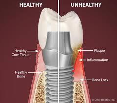 dental-implant-clinic-delhi