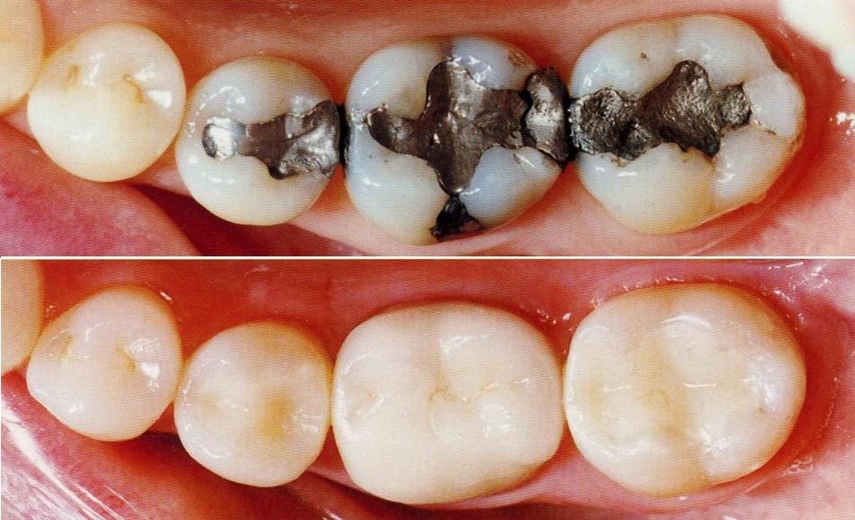 dental-implant-clinic-in-delhi-DII