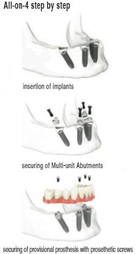 dental-implant-in-india-debtalimplant-india