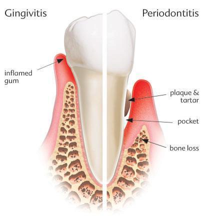 dental-implant-india-dental-clinic-in-asho-vihar
