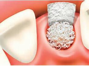 dental implants in India