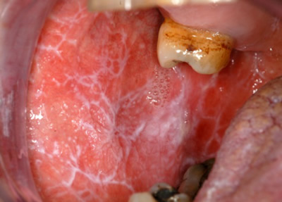 dental implants in India