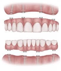 dentalimplantindia-dental-implant-clinic-in-delhi