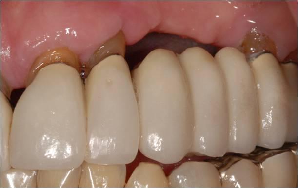 dentist-in-ashok-vihar-for-dental-inplant