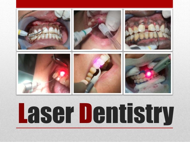 lasers used to remove tooth decay