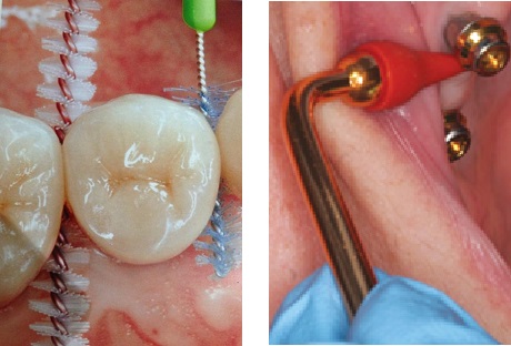 dental implants in delhi
