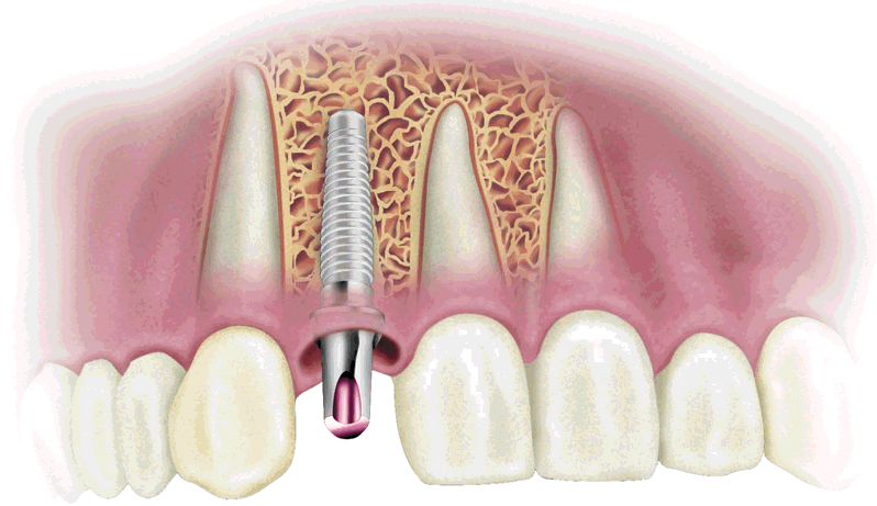 dental implants in delhi