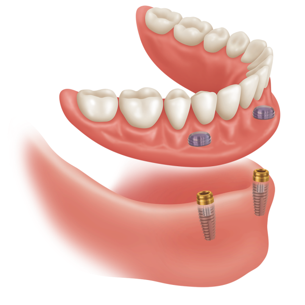 dental implant clinic in Delhi