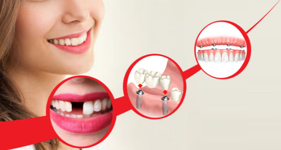 dental implant clinic in delhi